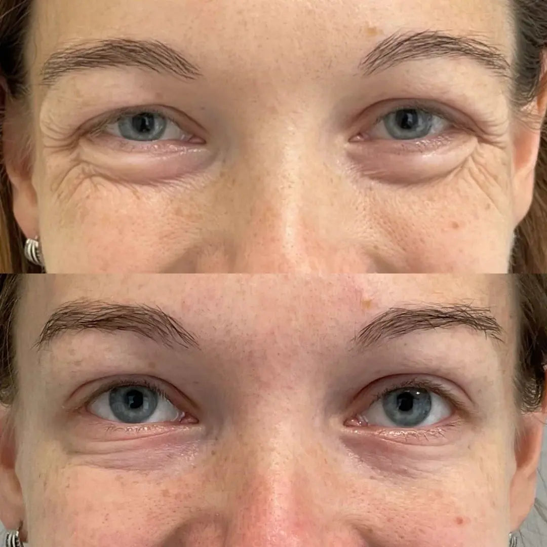 Rigèna - Thermo-Filler Patch ai Peptidi di Collagene