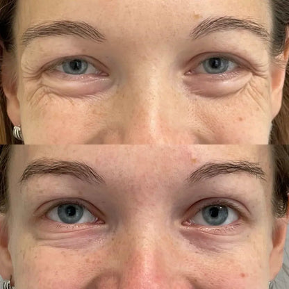 Rigèna - Thermo-Filler Patch ai Peptidi di Collagene