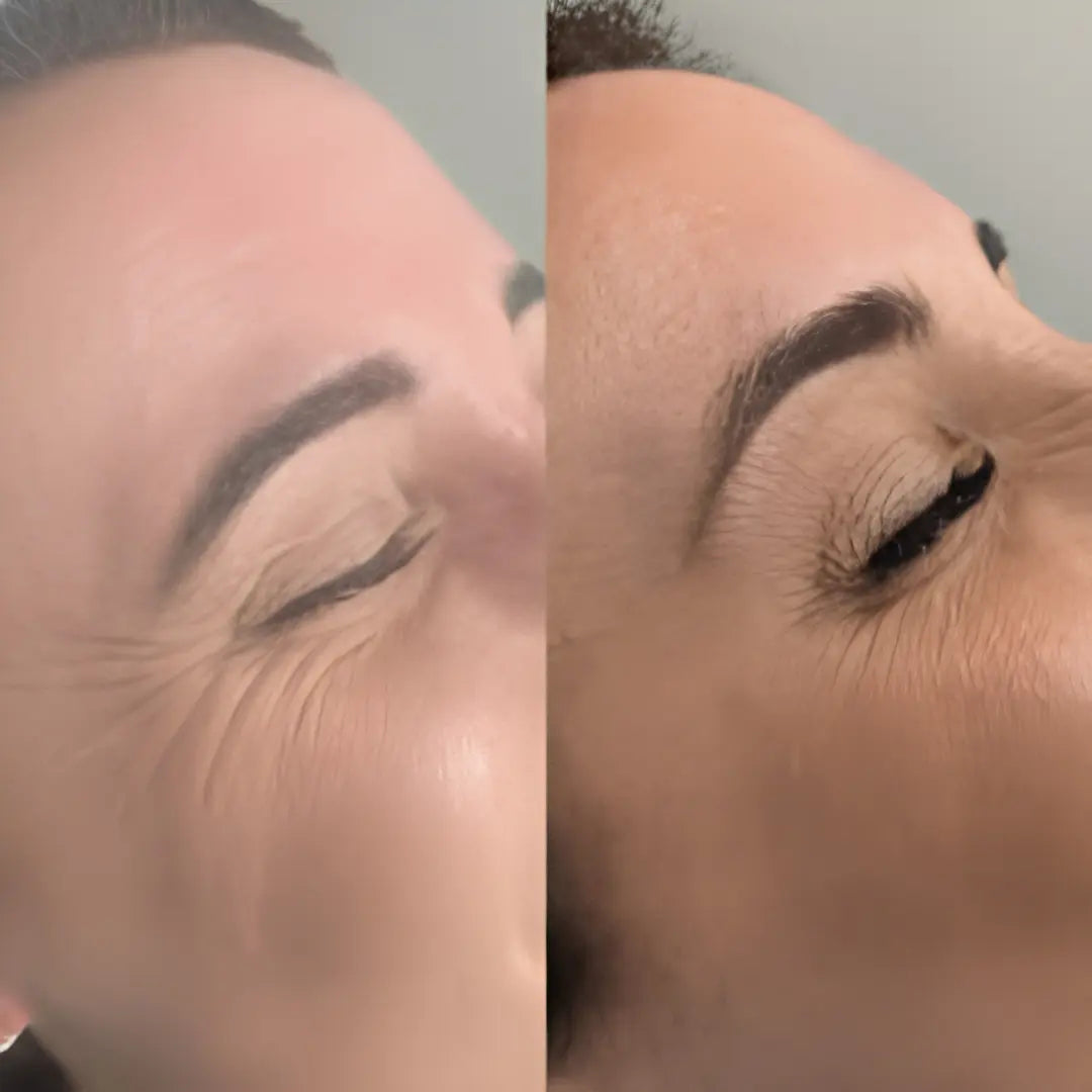 Rigèna - Thermo-Filler Patch ai Peptidi di Collagene