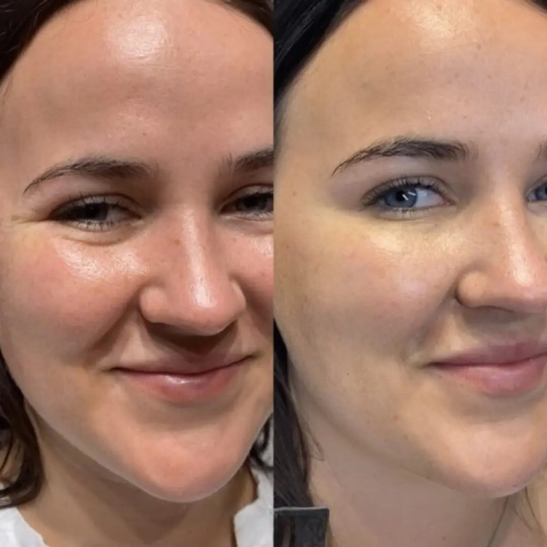Rigèna - Thermo-Filler Patch ai Peptidi di Collagene