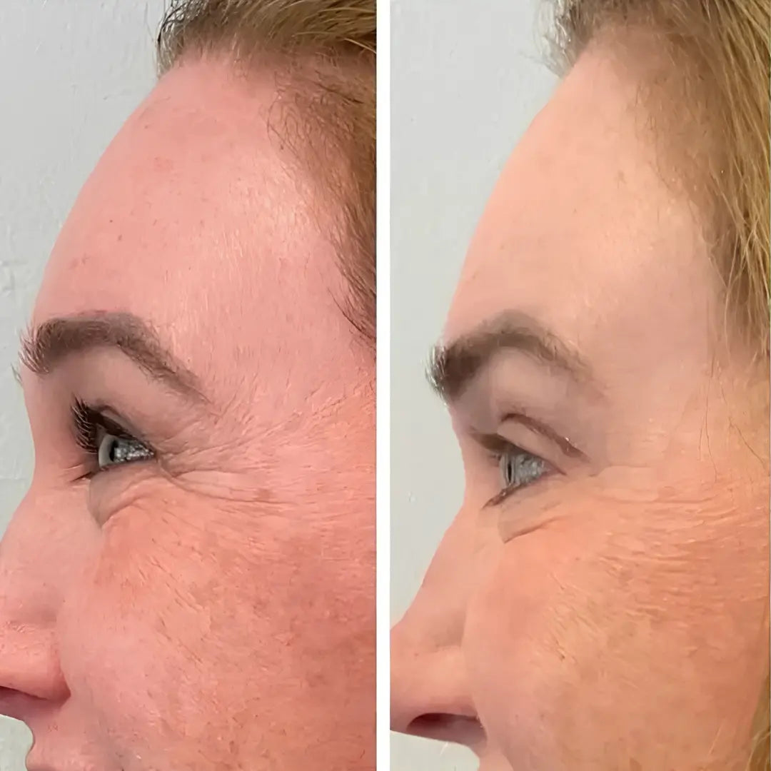 Rigèna - Thermo-Filler Patch ai Peptidi di Collagene