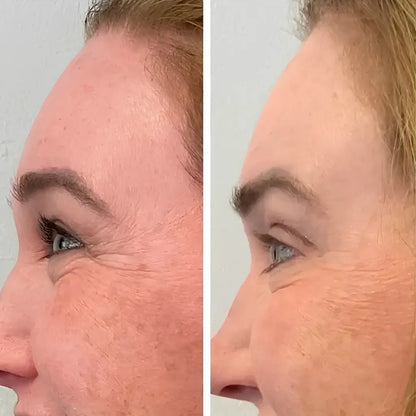 Rigèna - Thermo-Filler Patch ai Peptidi di Collagene